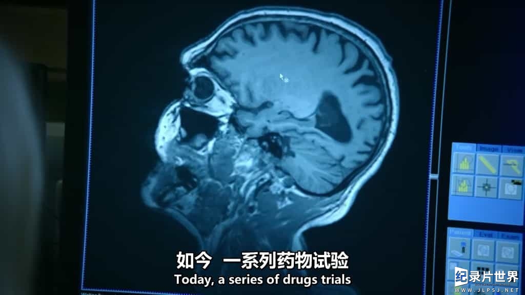 BBC纪录片/地平线系列《治愈阿尔茨海默病 Curing Alzheimer's 2016》英语中英双字